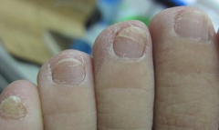 灰指甲用什么有效？知足抗菌足膜能根治